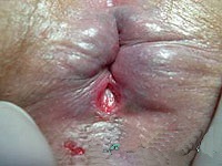 analcrack_005_chronic_posterior.jpg