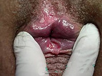 analcrack_006_chronic_posterior.jpg