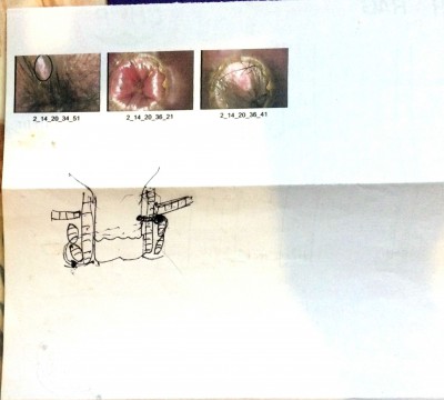 Fistula Diagnosis(1)-3.jpg
