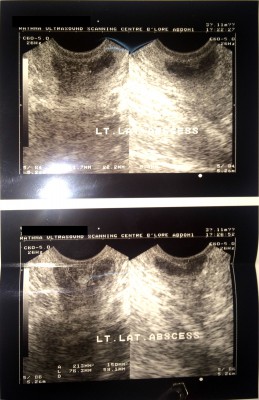 Fistula Diagnosis(1)-6.jpg