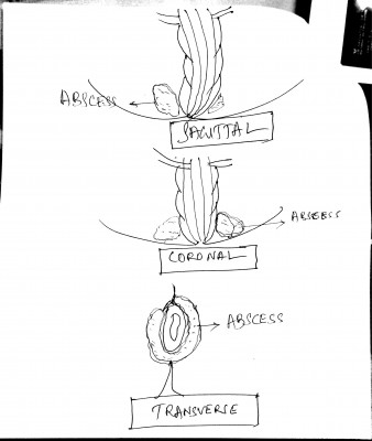 Fistula Diagnosis(1)-5.jpg